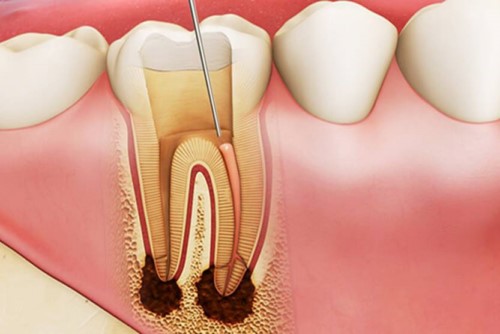Nha khoa chữa tủy răng uy tín tại TPHCM-03