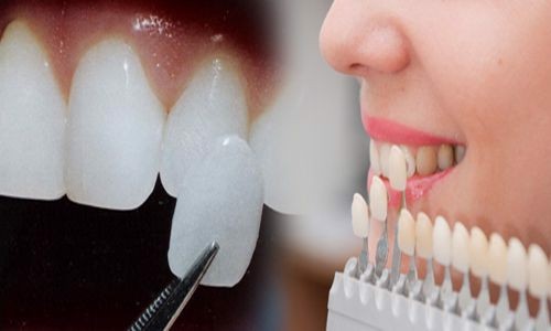 Nha khoa uy tín bọc răng sứ chất lượng tại TPHCM-04