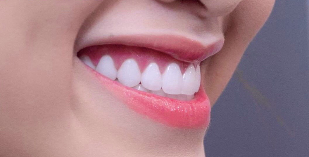 Có nên bọc răng sứ thẩm mỹ nguyên hàm hay không-03